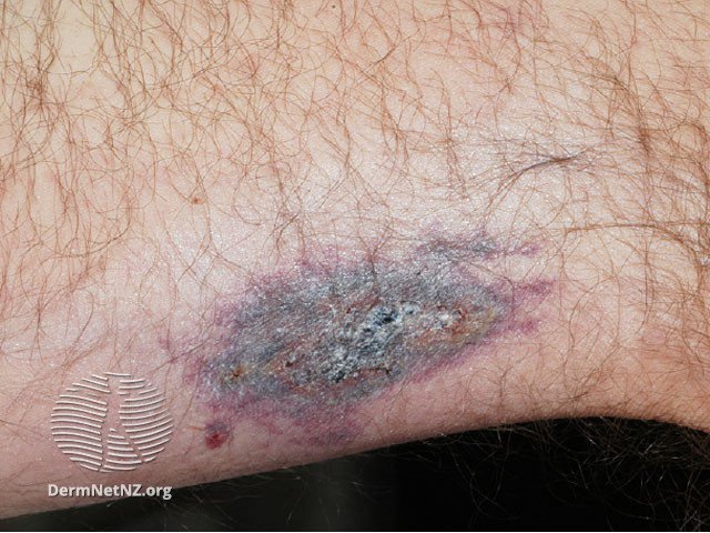 Calciphylaxis - skin lesions