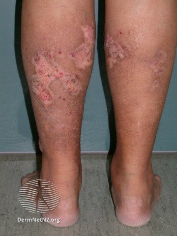 Calciphylaxis - ulcers
