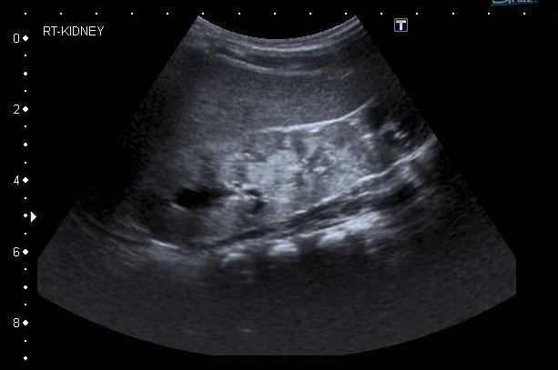 Kidney ultrasound scan