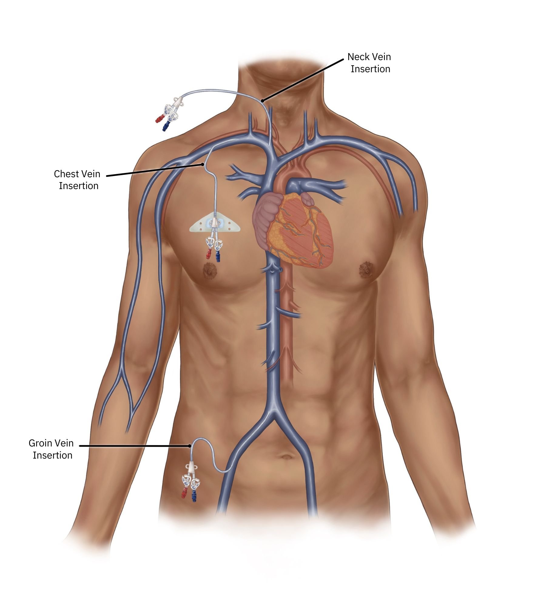 Haemodialysis access with a tunnelled line | Kidney Care UK