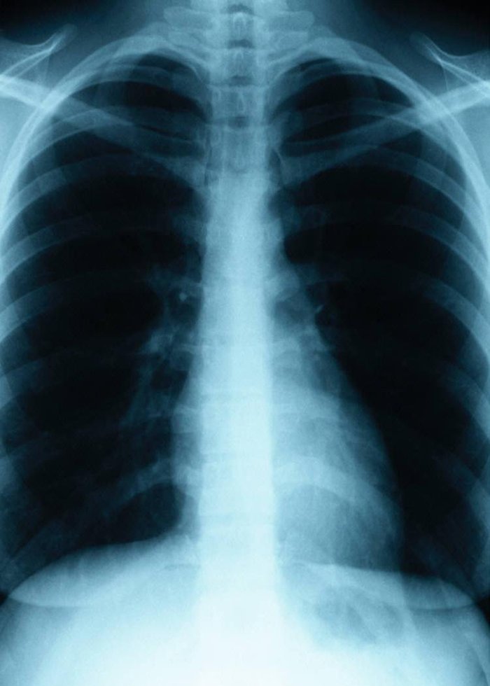 X-ray lungs