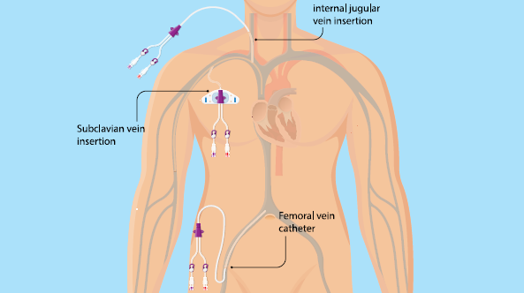 haemodialysis - inserting your catheter - diagram