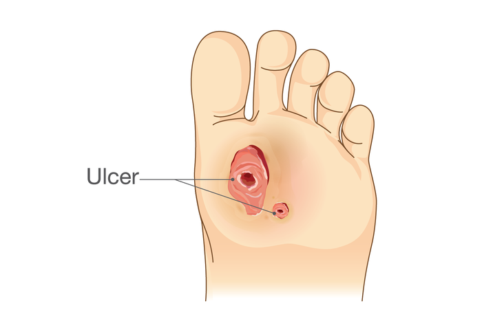 Foot ulcer illustration