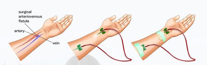 vascular access - AV fistula - AV fistula diagram